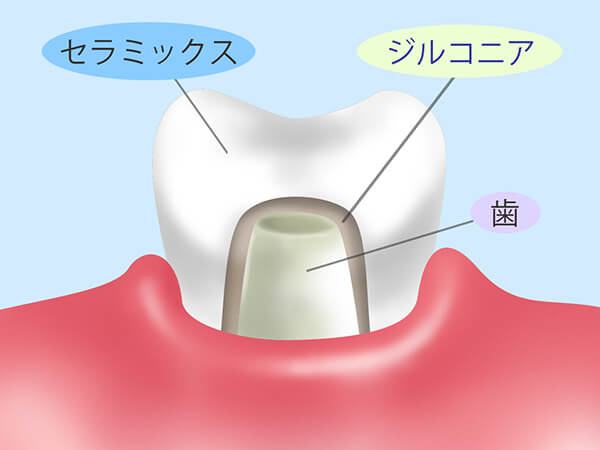 セラミック治療は保険診療と何が違うの・・・?